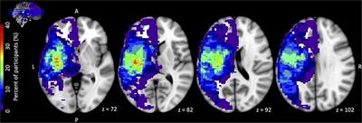 Clinical Imaging-Derived Metrics of Corticospinal Tract Structural Integrity Are Associated With Post-stroke Motor Outcomes: A Retrospective Study